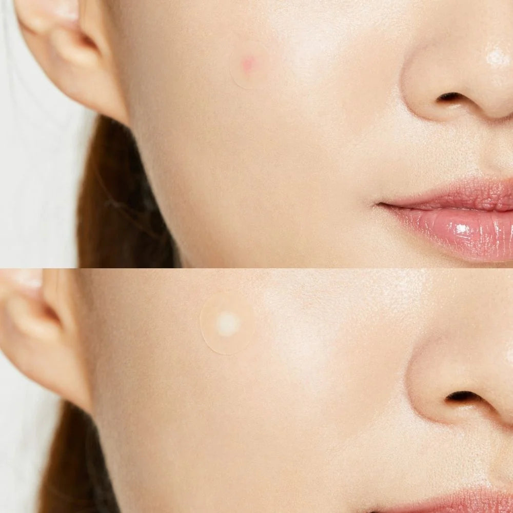 COSRX - ACNE PIMPLE MASTER PATCH