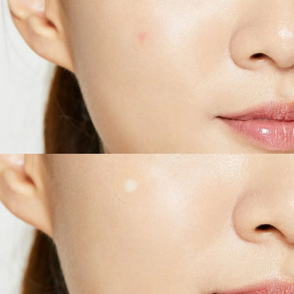 COSRX - ACNE PIMPLE MASTER PATCH